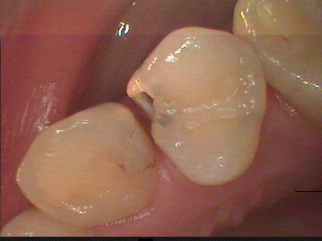 犬歯と隣の小臼歯の形は大きく異なるのでここは細菌の好発地になり易い所です。その為ここに虫歯の発生が良く見られます。
