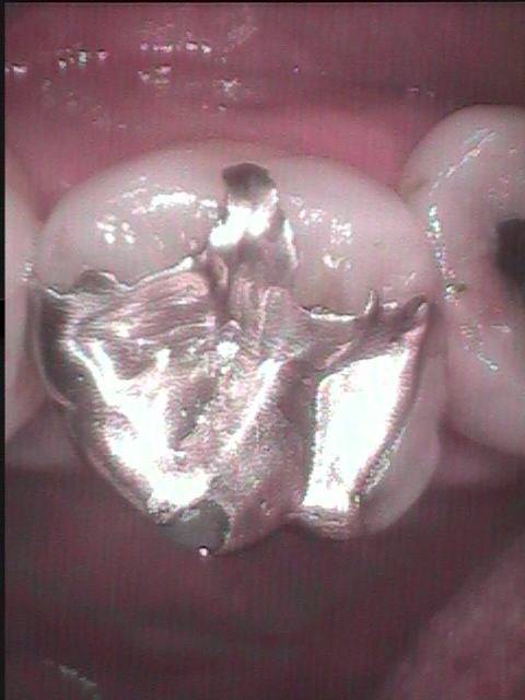 虫歯治療した後にまた再発するのは金属充填治療をするからです。最新の治療はこの再発を防ぎます。