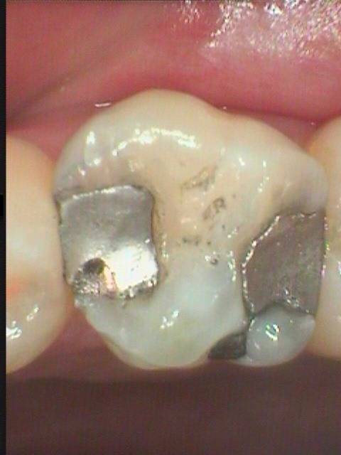 古い金属充填の下に虫歯が再発するのは宿命的です。再発を防ぐためには歯に強く接着する素材で治療する事が大切です。