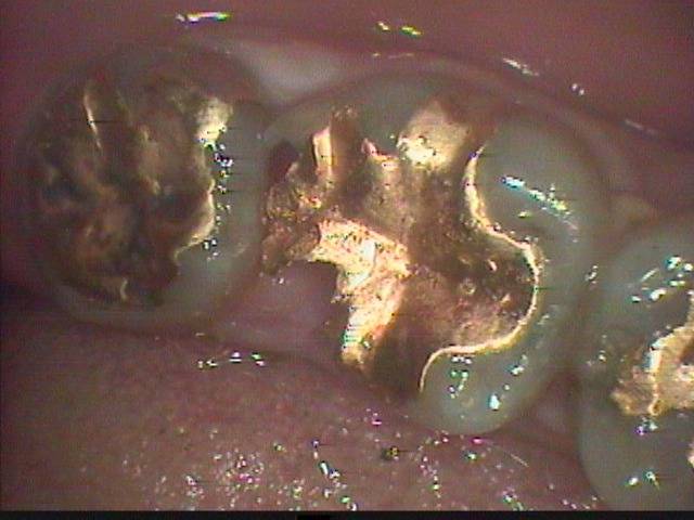 感染根管治療の症例です。金属インレーの下に大きな虫歯が進み、神経が細菌感染がしていました。