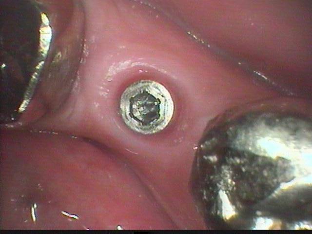 入れ歯だった所にインプラントを入れた症例です。入れ歯とは比べものが無いほど具合が良いようです。