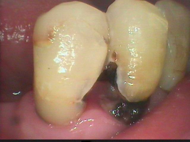 下顎前歯部に大きな虫歯が発生していました。早く治療すればよかったのですが、神経にまで細菌感染が進んだので、感染根管治療をしました。