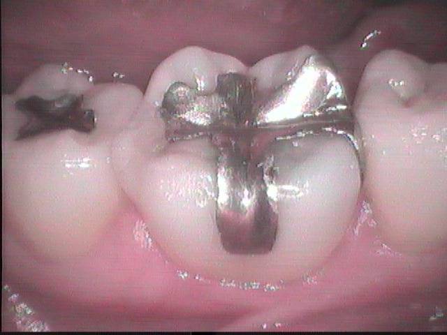 虫歯治療を一度されていましたが、また再発した症例です。虫歯治療に金属を詰めるとまた再発する可能性が有ります。