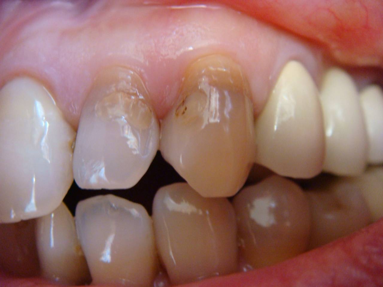大きく変色した前歯も審美治療で綺麗に治ります。