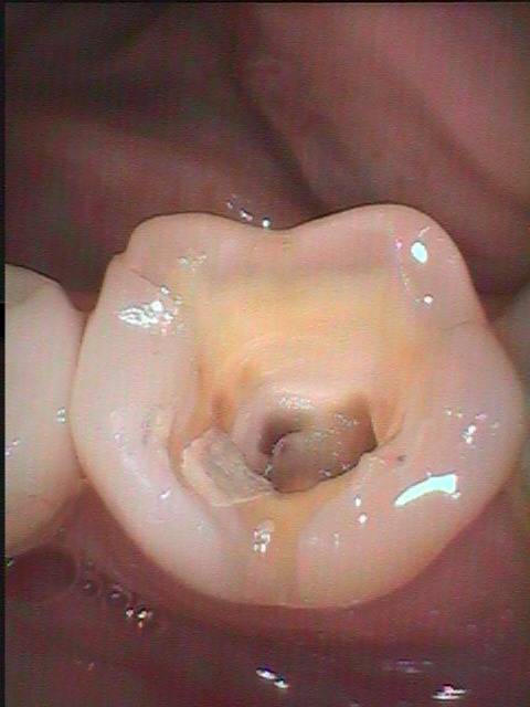 大臼歯と小臼歯の感染根管治療を順番に行った症例です。