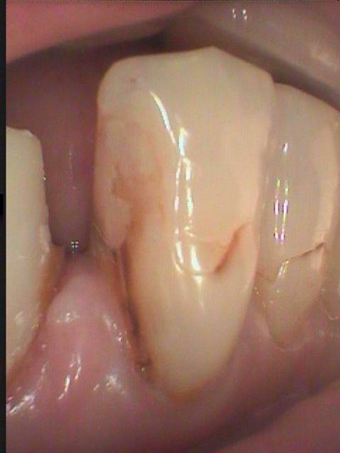 虫歯がかなり進んでいた症例です。もう少しで歯髄（神経）を取る所まで細菌感染していました。