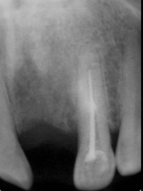 前歯と小臼歯との根管治療です。それぞれの根管内に虫歯の細菌が侵入し、ここが格好の細菌培養地になり、腫れたり顎の骨が炎症を起こしていました。