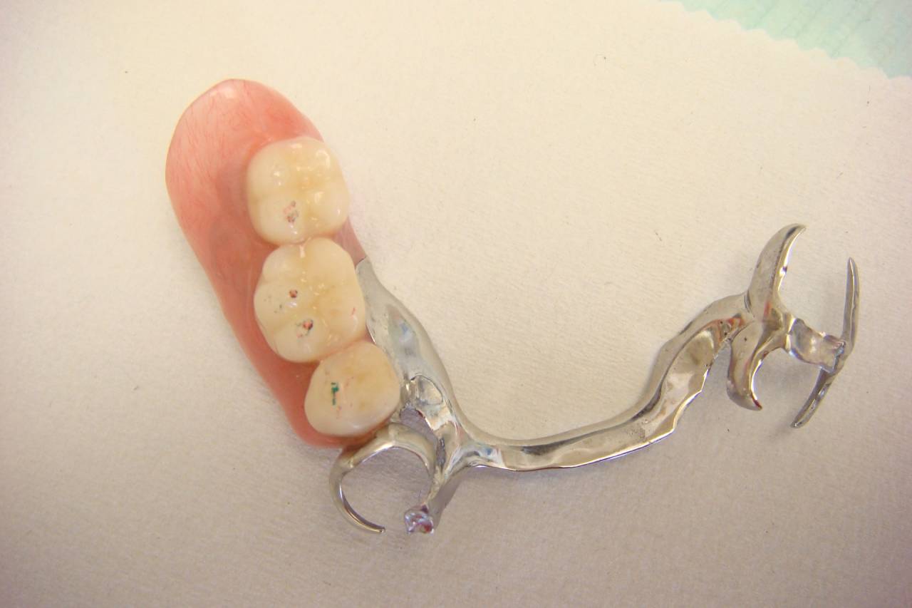 当医院は総入れ歯も部分入れ歯も得意にしています。今回の部分入れ歯も具合が良くて、入れてから10年間そのまま使われています。