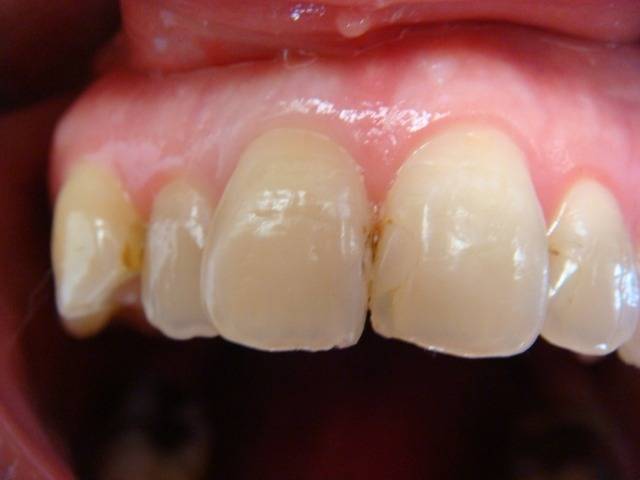 隣りの歯との間に細菌が貯留して虫歯が出来ました。虫歯を取って、歯と同じ色の素材を詰めました。