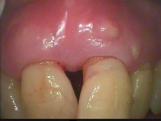 前の歯２本が歯周病と根尖性歯周炎でした。痛みを取る為、先に感染根管から始めました。　　　　　　　　　　