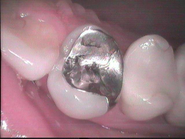 虫歯治療はその後にまた再発しない様な治療をするべきです。その点、昔からの金属を詰める治療法は避けるべきです。　　　　　　　　　　
