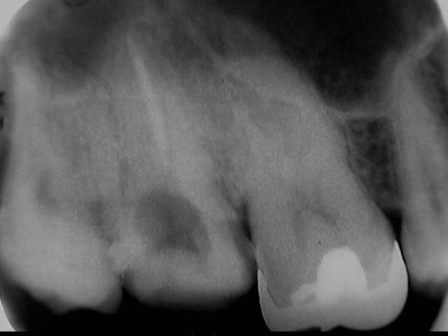 感染根管治療の症例です。上顎第二大臼歯の根管治療は手が届きにくく、一般ではやり辛い所ですが、当医院ではその沢山の実績を重ねています。