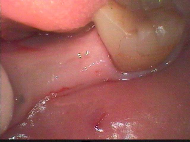 インプラントの症例です。歯が抜けた所を入れ歯で治すかどうか、患者様は迷われましたが、総合的に判断して結局インプラントを選択されました。