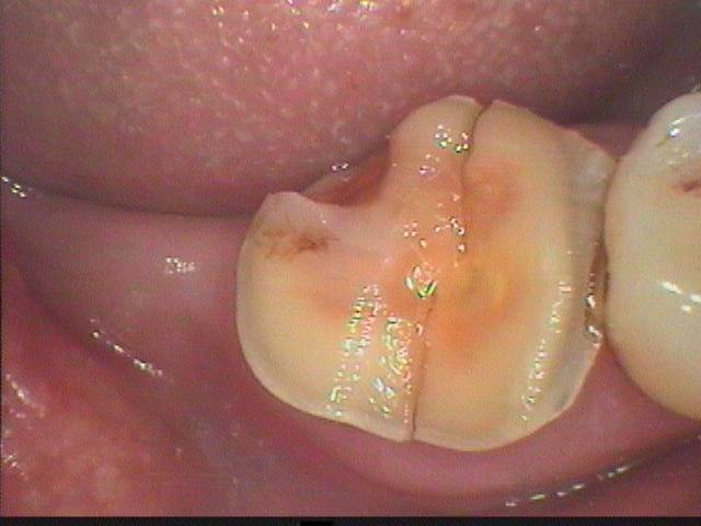歯が真っ二つに割れて抜歯の予定でしたが、できるだけ抜きたくないとの患者様の希望で延命を図りました。