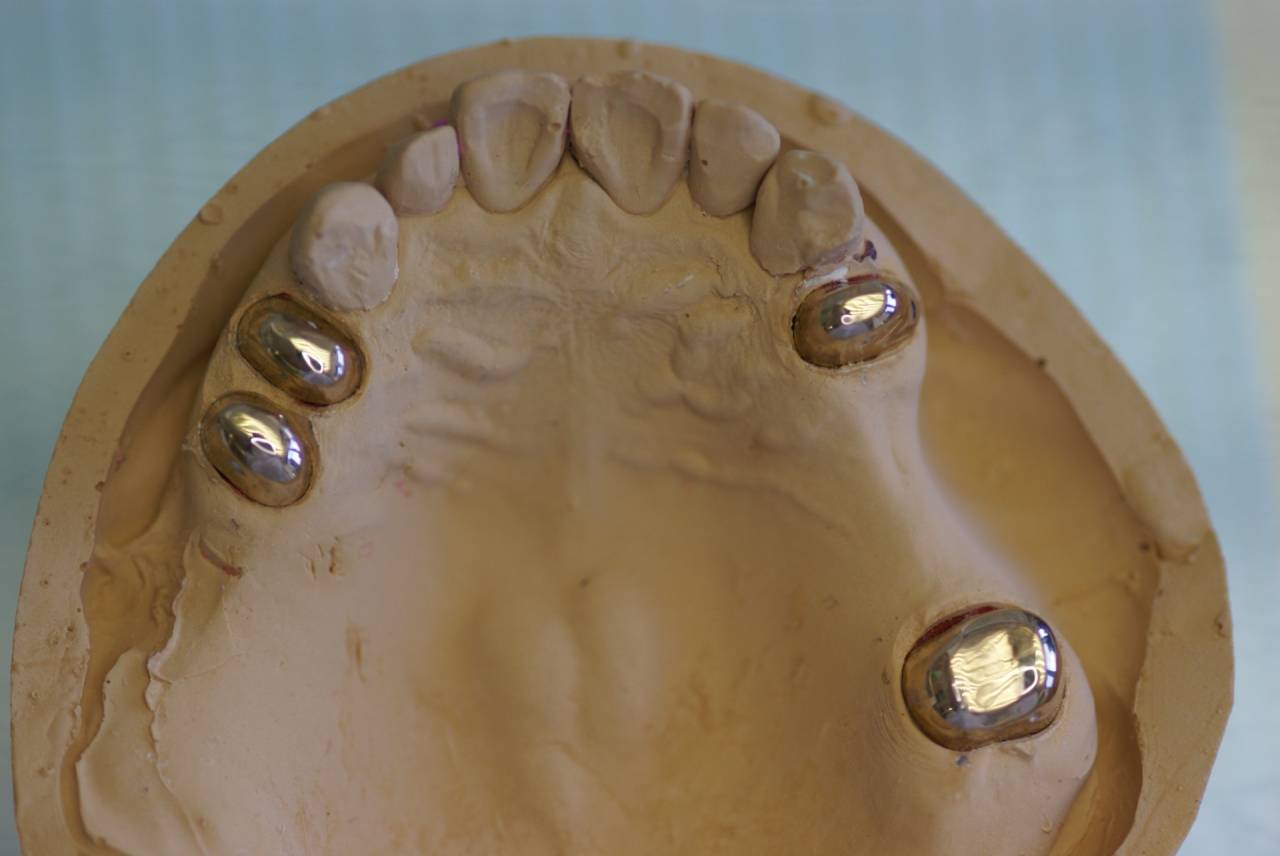 入れ歯には色々なタイプがあります。通常は入れ歯を口の中で維持するため、歯にバネのようなものをかけます。これが前の歯だと目立つことがあるので嫌がる方がおられます。このような時に応用されるのが今回の症例のコーヌステレスコープです。