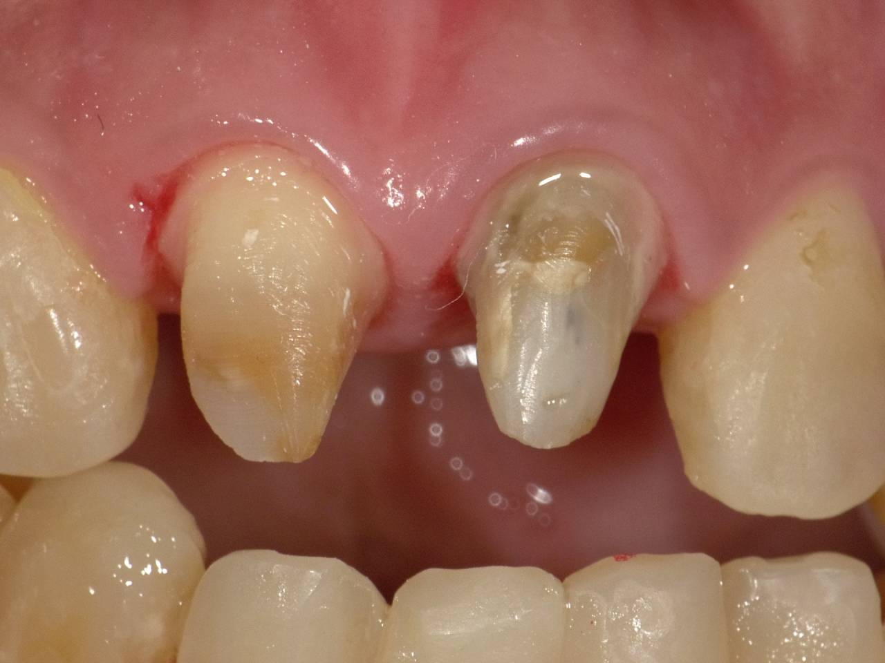 前歯部のクラウンによる修復です。正確な形成と精密な型取りが求められる治療です。