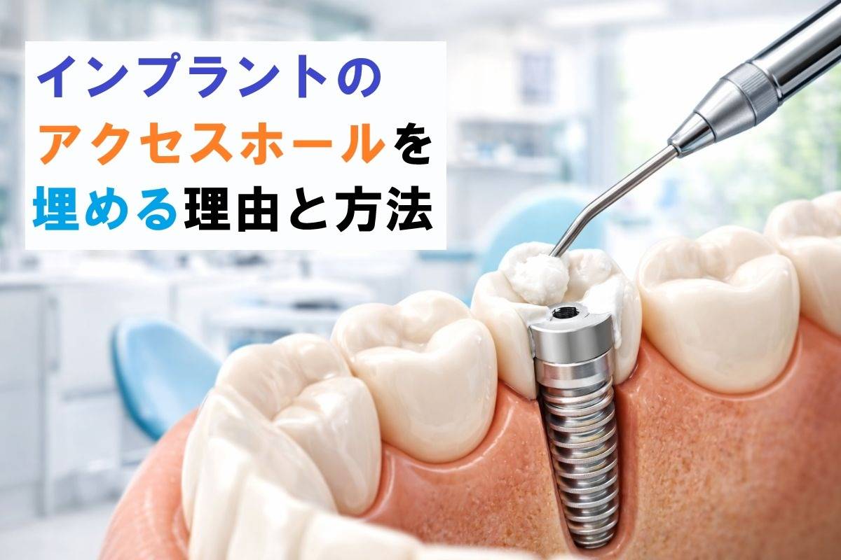 インプラントのアクセスホールを埋める理由と方法